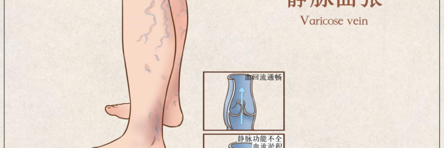 告別“蚯蚓腿”，靜脈曲張怎么調(diào)？