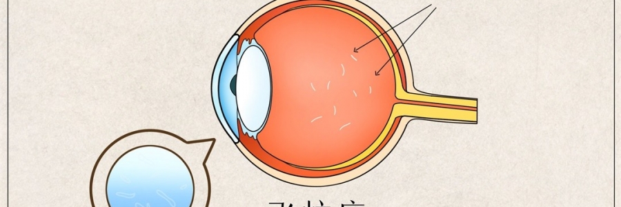 “蚊子”在眼里飛？這類人要注意了！