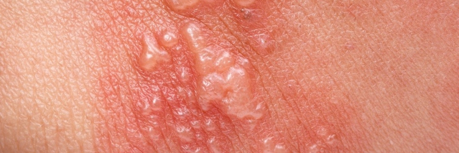 艾灸后起了小水泡，居然是邪氣在“逃跑”！