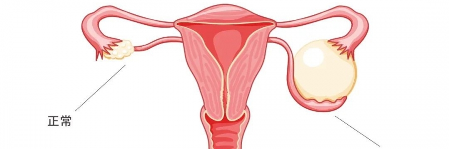 太神奇了，艾灸調(diào)好了她的卵巢囊腫！